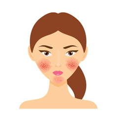 Acne rosacea Acne rosacea