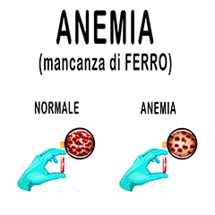 Anemia da carenza di ferro Anemia da carenza di ferro